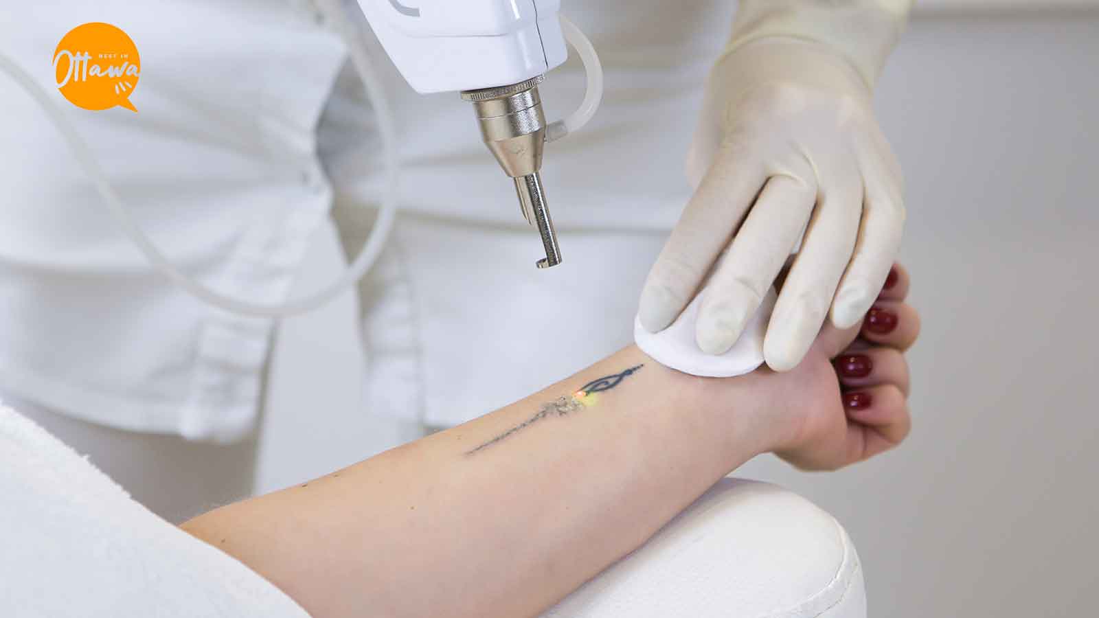Best Tattoo Removal in Ottawa