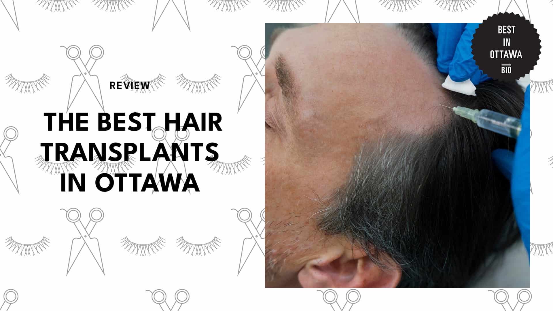 Best Hair Transplants