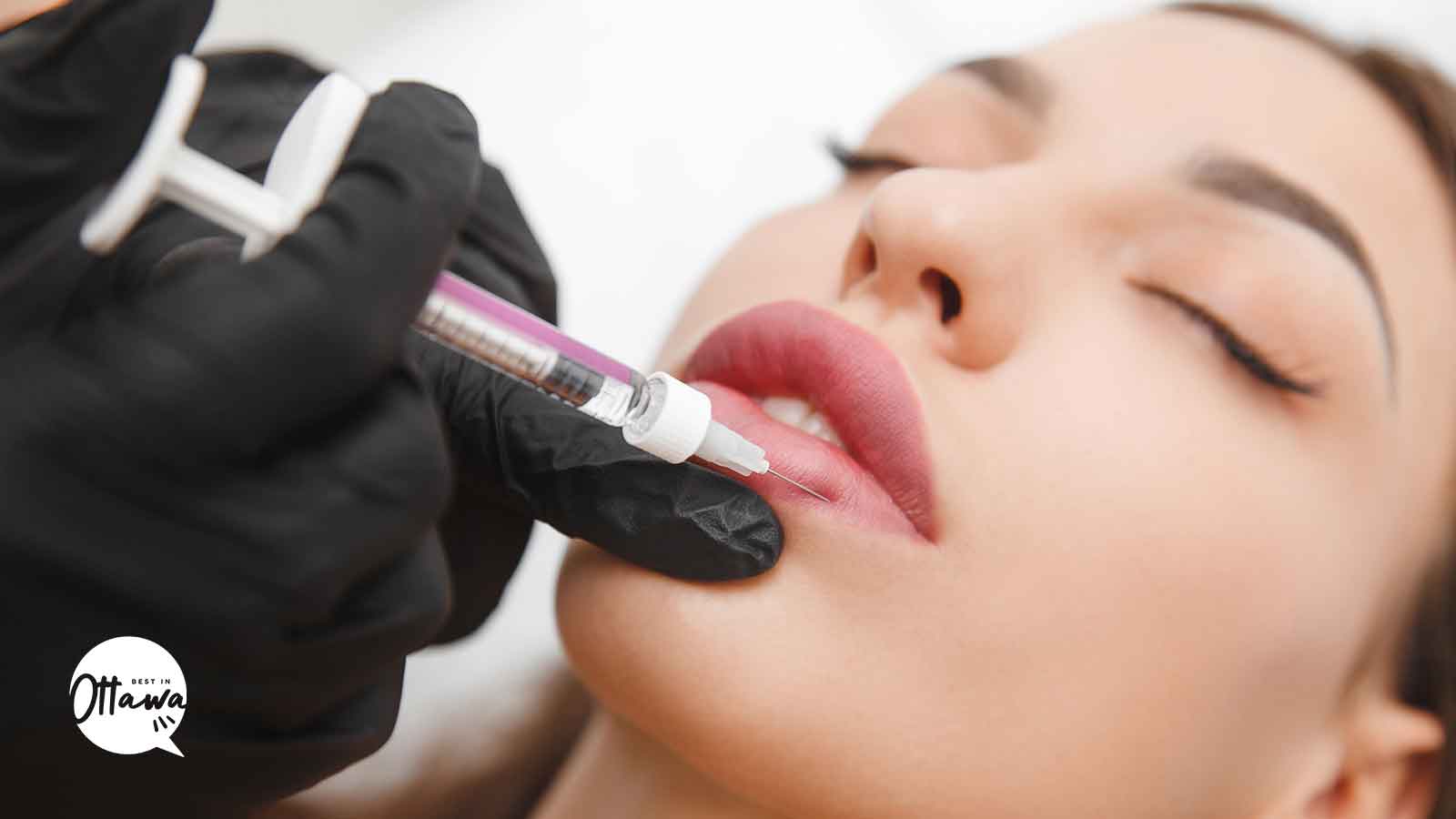 Best Lip Fillers in Ottawa