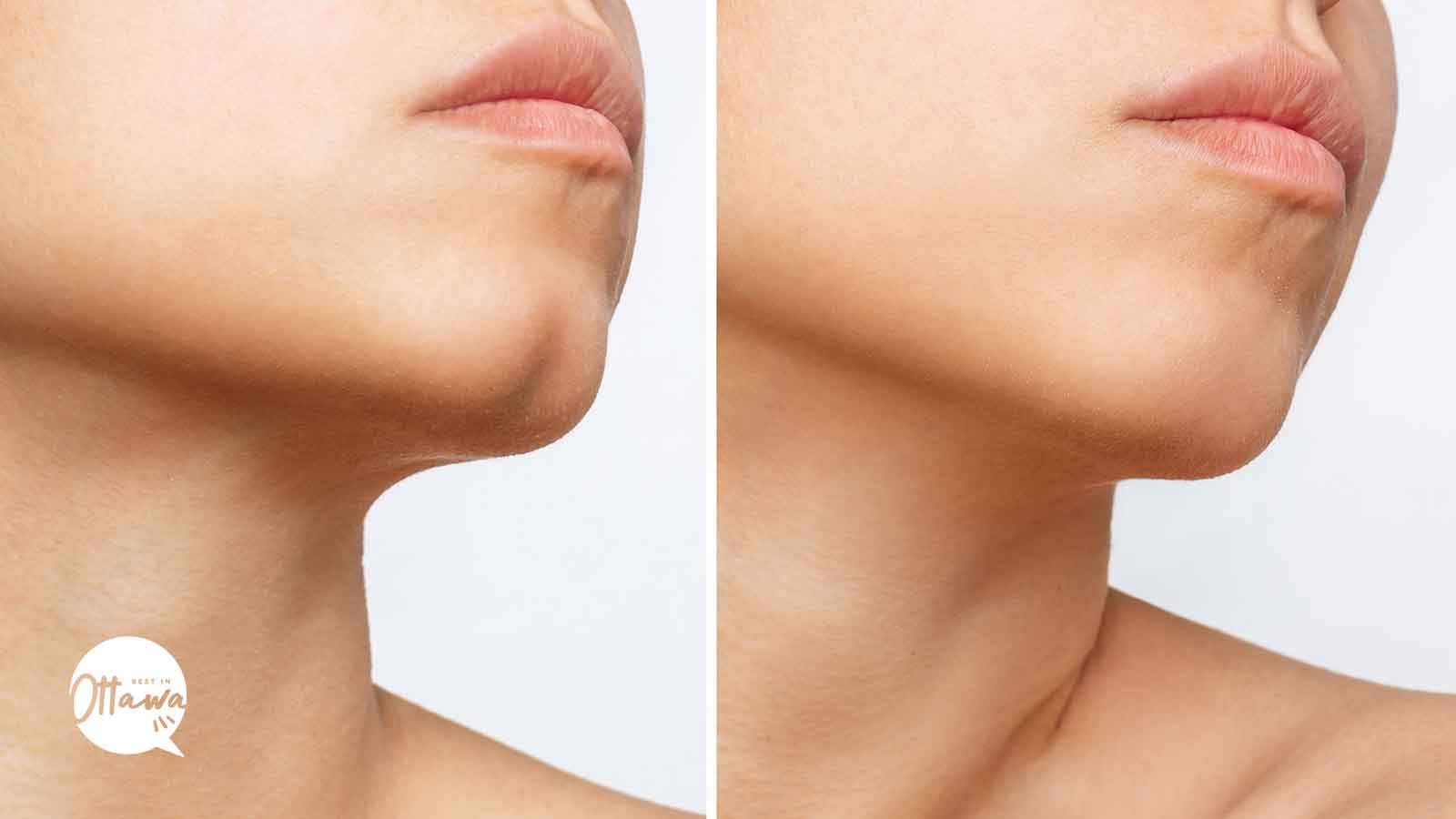 Best Clinics for Chin Fillers in Ottawa