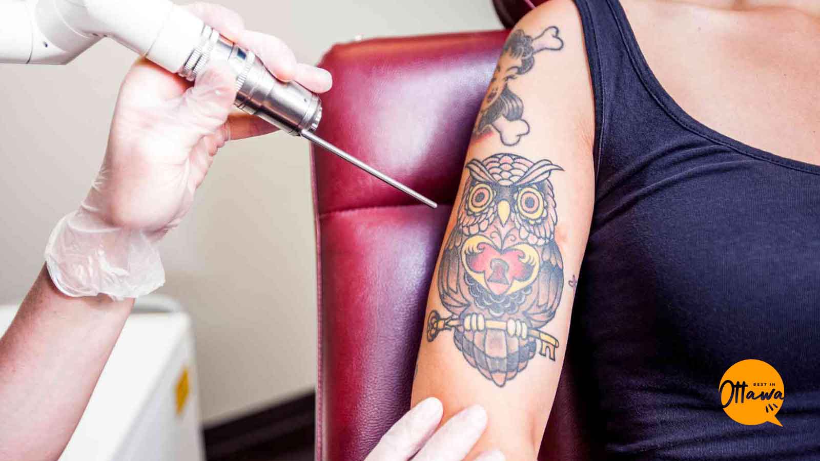 Best Laser Tattoo Removal Clinics in Ottawa
