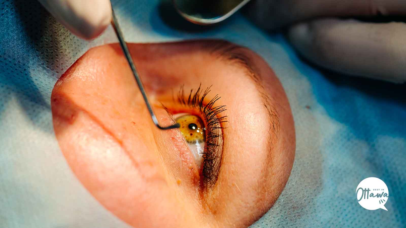 Best Clinics for Retinal Detachment Surgery in Ottawa