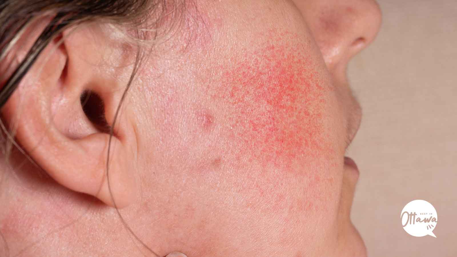 Best Pigmentation Treatment Clinics in Ottawa