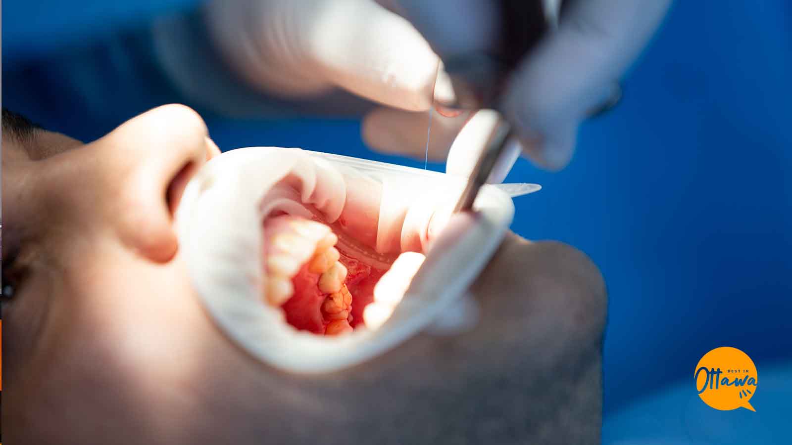 Best Clinics for Root Canal Treatment in Ottawa