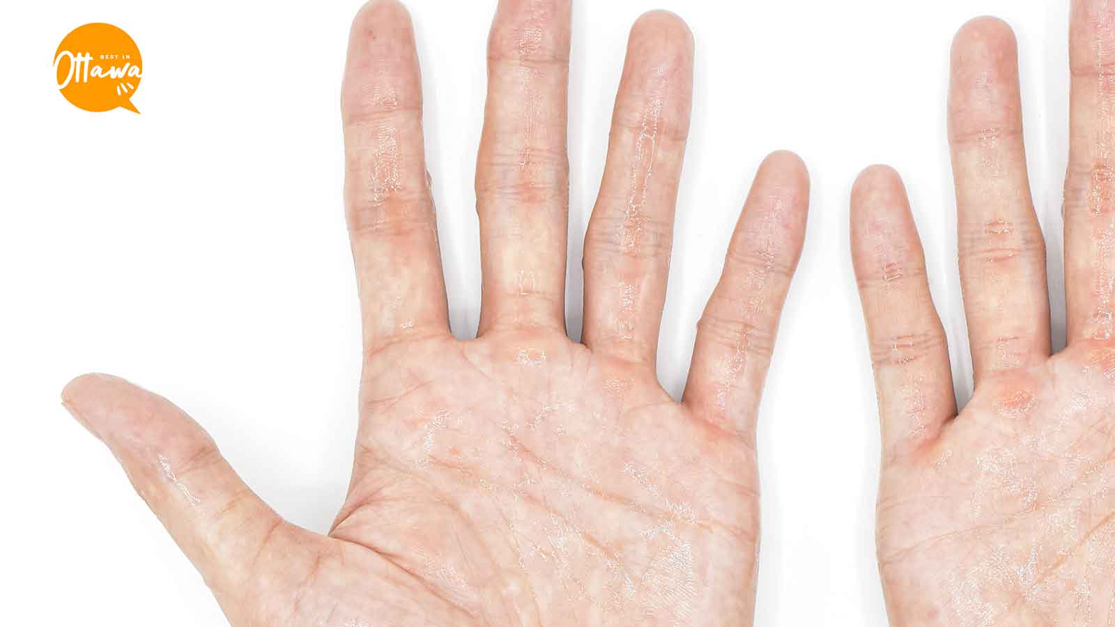 Best Clinics for Sweaty Palms Surgery in Ottawa